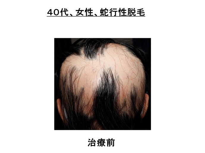 円形脱毛症　病院